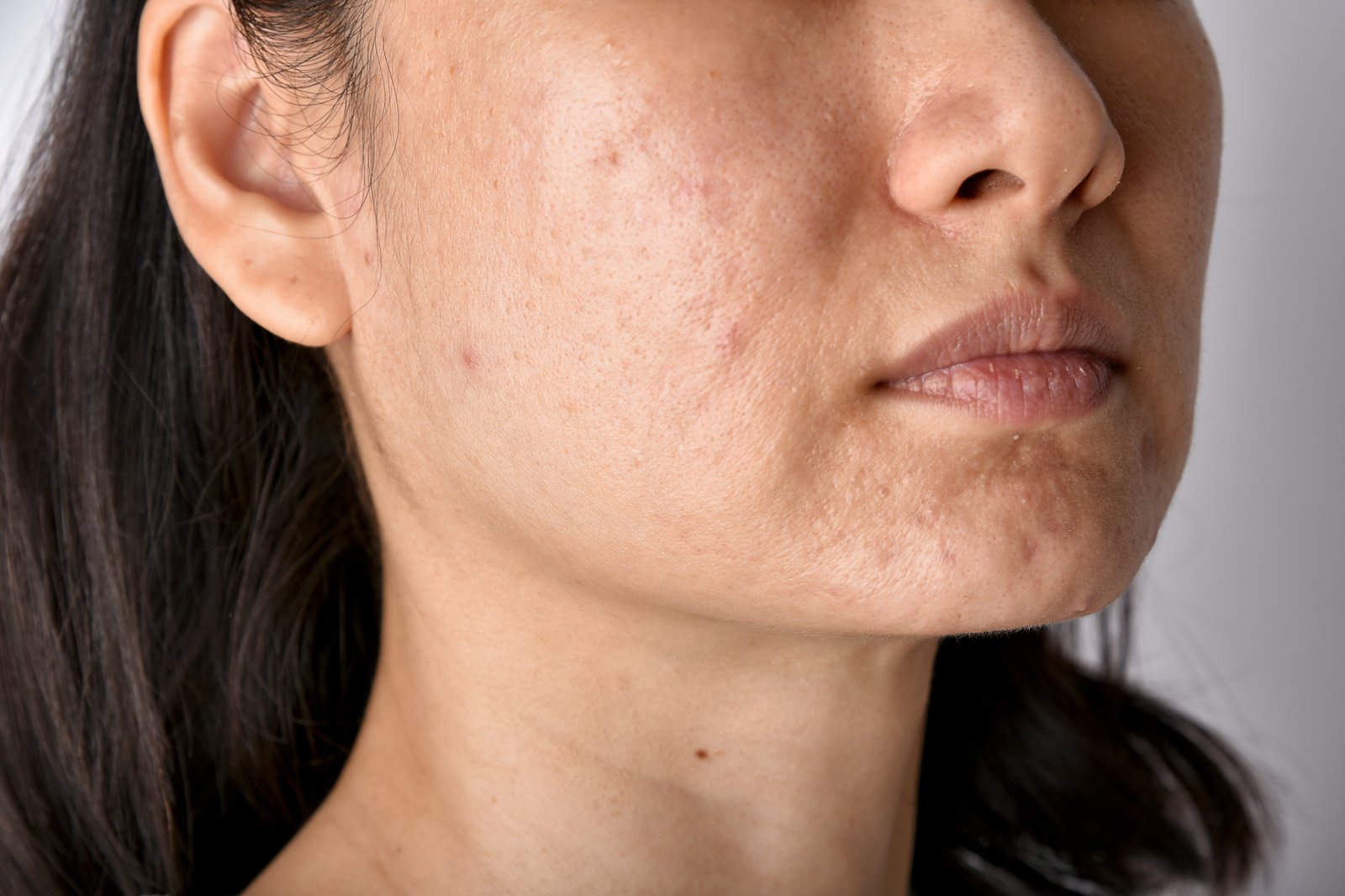 Acne scars