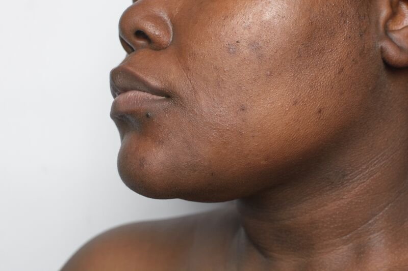 Hyperpigmentation