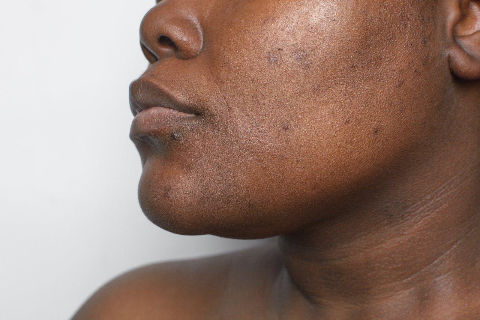 Hyperpigmentation